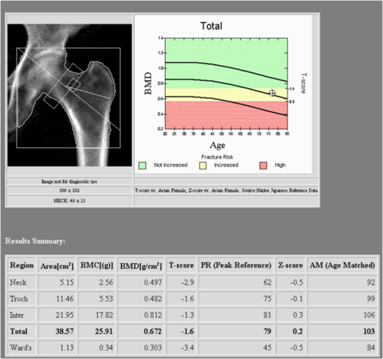 bmd-bone-mineral-densitometry