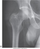 intertrochanteric fracture femur