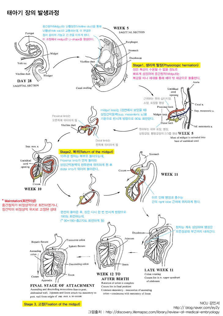 Omphalocele (정의, 장의 발생과정(생리적 탈장(physiologic Herniation) 장의 복귀(return Of 