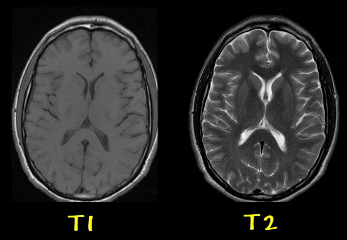 MRI 원리와 T1, T2 특징 : 네이버 블로그