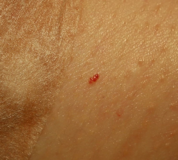 Collection 101+ Images Cherry Angioma On Scalp Pictures Superb 10/2023