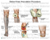 BK(Below Knee) Amputation : 네이버 블로그