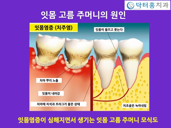 잇몸 고름주머니, 원인과 치료법 : 네이버 블로그 잇몸 고름주머니, 원인과 치료법 : 네이버 블로그