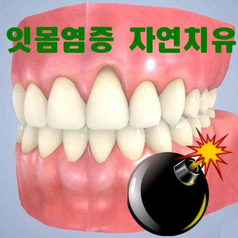 잇몸염증, 자연치유 비치료 : 네이버 블로그