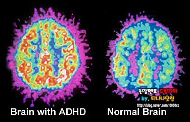 드림카파의 건강 리얼정보 주의력결핍 과잉행동장애 원인 증상 : 네이버 블로그