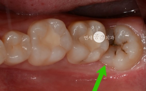 사랑니 발치 비용이 싼 이유 네이버 블로그