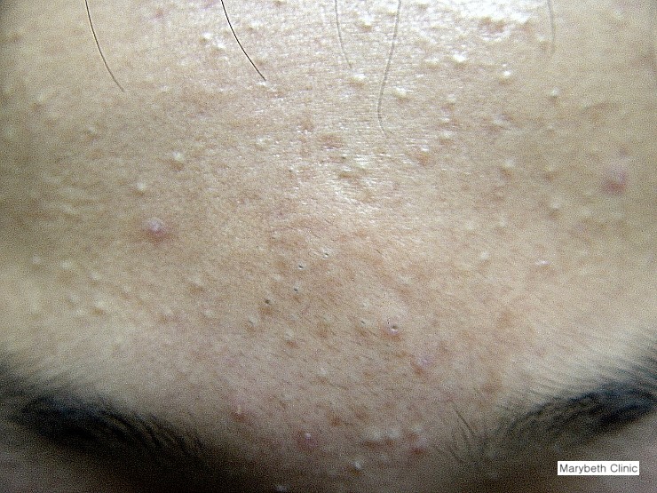 피부질환 백과사전﻿﻿ 68. 면포여드름 (면포성 여드름, Acne comedonica) 네이버 블로그