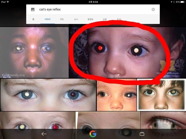 Cat's eye reflex 고양이 눈반사로 눈암(안암)을 미리 발견 네이버 블로그