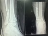 cpt orif distal fibula fracture