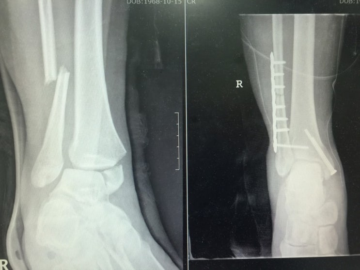 ORIF Distal fibular shaft, medial malleolus, syndesmosis fixation 네이버 블로그