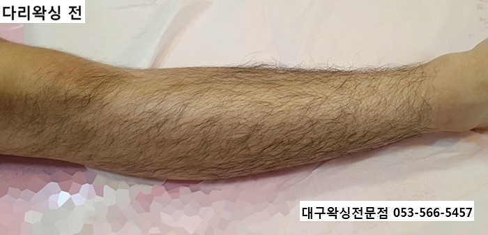 대구 다리왁싱 남자 다리 털 왁싱 후기 네이버 블로그