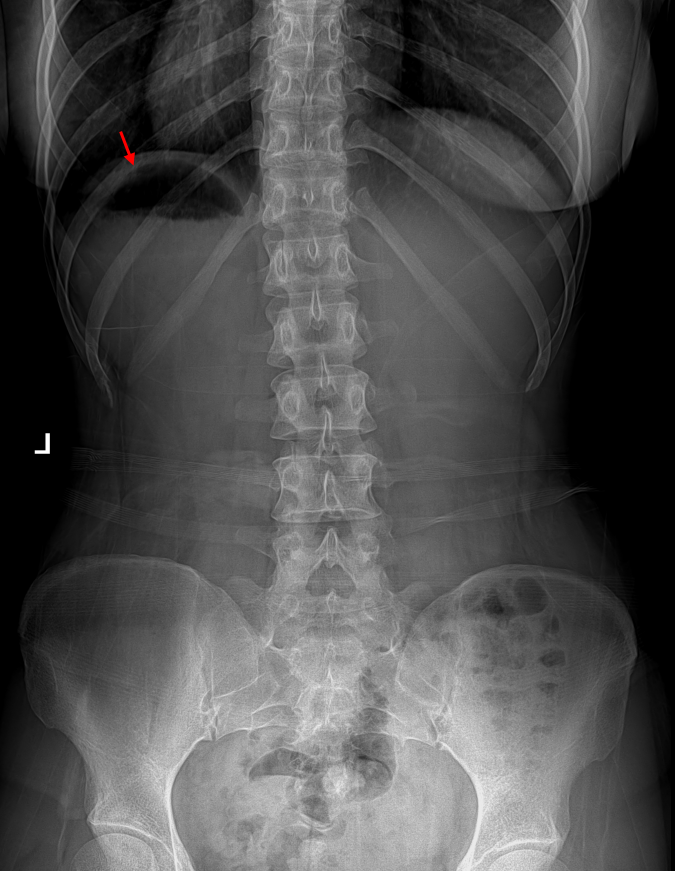 1-gas-bubbles-stomach