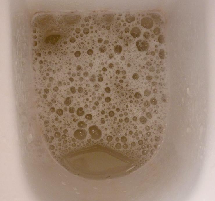 Dark Colored Foamy Urine