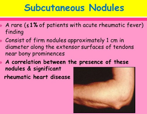 rheumatic fever : 네이버 블로그