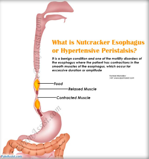 nutcracker esophagus 네이버 블로그