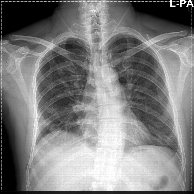늑골연골염과 폐렴, Costochondritis and pneumonia 네이버 블로그