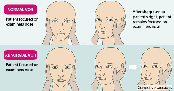 두부충동검사(head thrust test) : 네이버 블로그