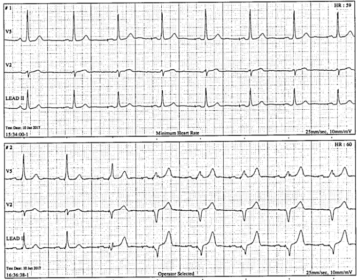 ddd-pacemaker-ecg