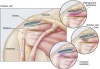 rotator cuff impingement