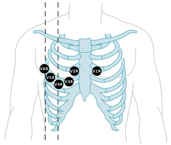 Right Ventricular Myocardial Infarction Ë¤ì´ë² Ë¸ë¡ê·¸