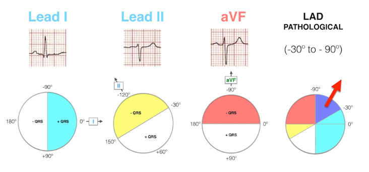 ekg-left-axis-deviation-lad-right-axis-deviation