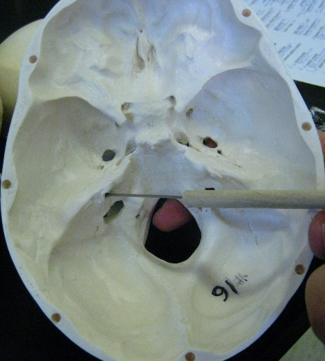 internal auditory meatus : 네이버 블로그