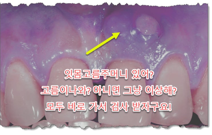 잇몸고름주머니 물혹 구상상악낭종(Globulomaxillary Cyst) 차이점은? : 네이버 블로그