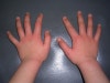 소아 PPGSS(Papular Purpuric Golves And Socks Syndrome) 피부질환 : 네이버 블로그